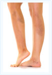 Clinica Varicoline - varice